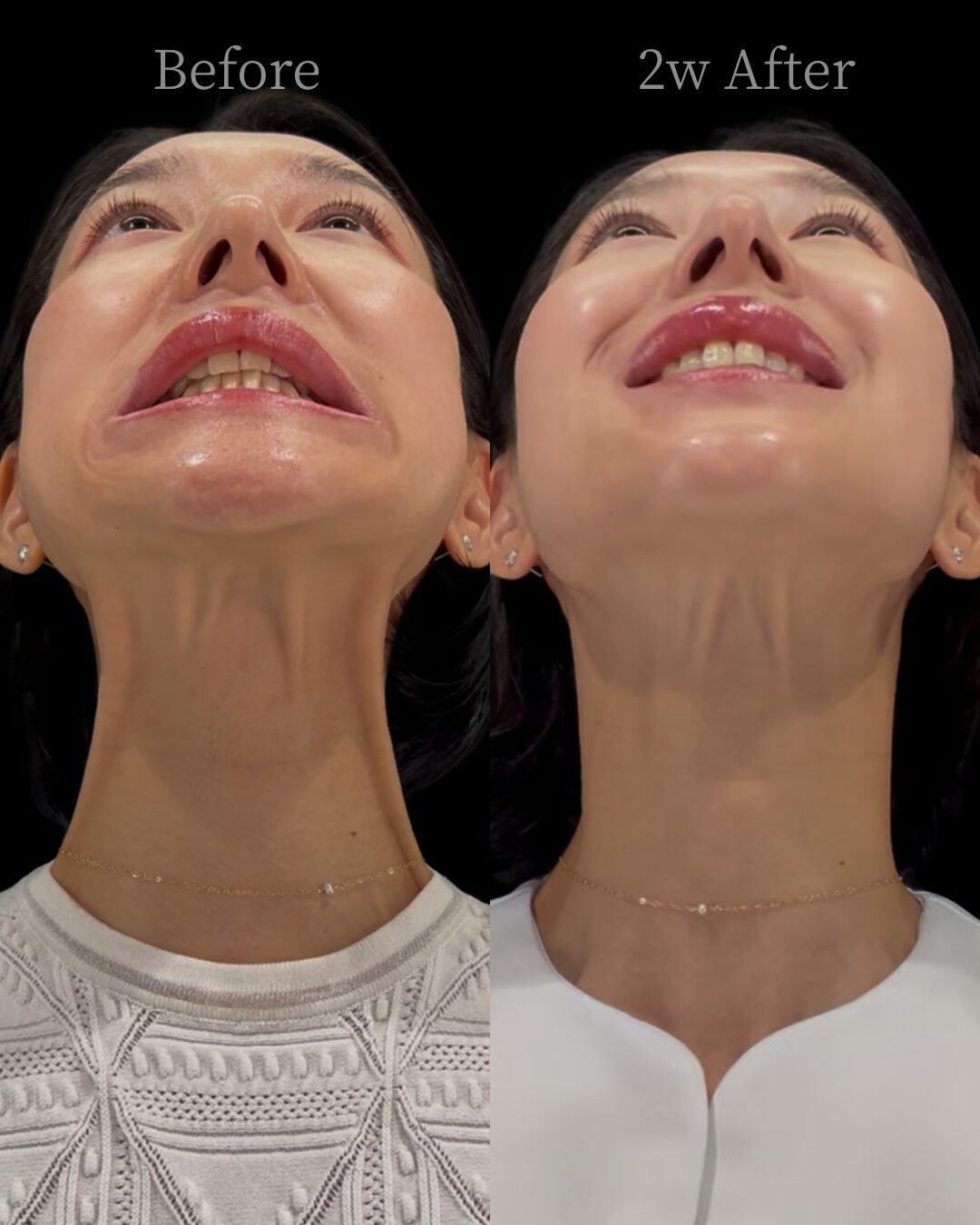 Botox neck Rejuvenation in Tokyo: Aesthetic Surgery Insights and medical spa Care by Dr. Airi Yokoyama
