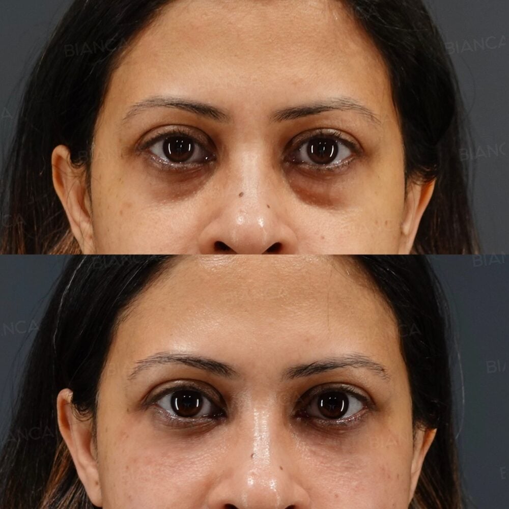 Under-Eye Filler in Tokyo: Doctor-Led Aesthetic Surgery and medical spa Care for Brighter Eyes