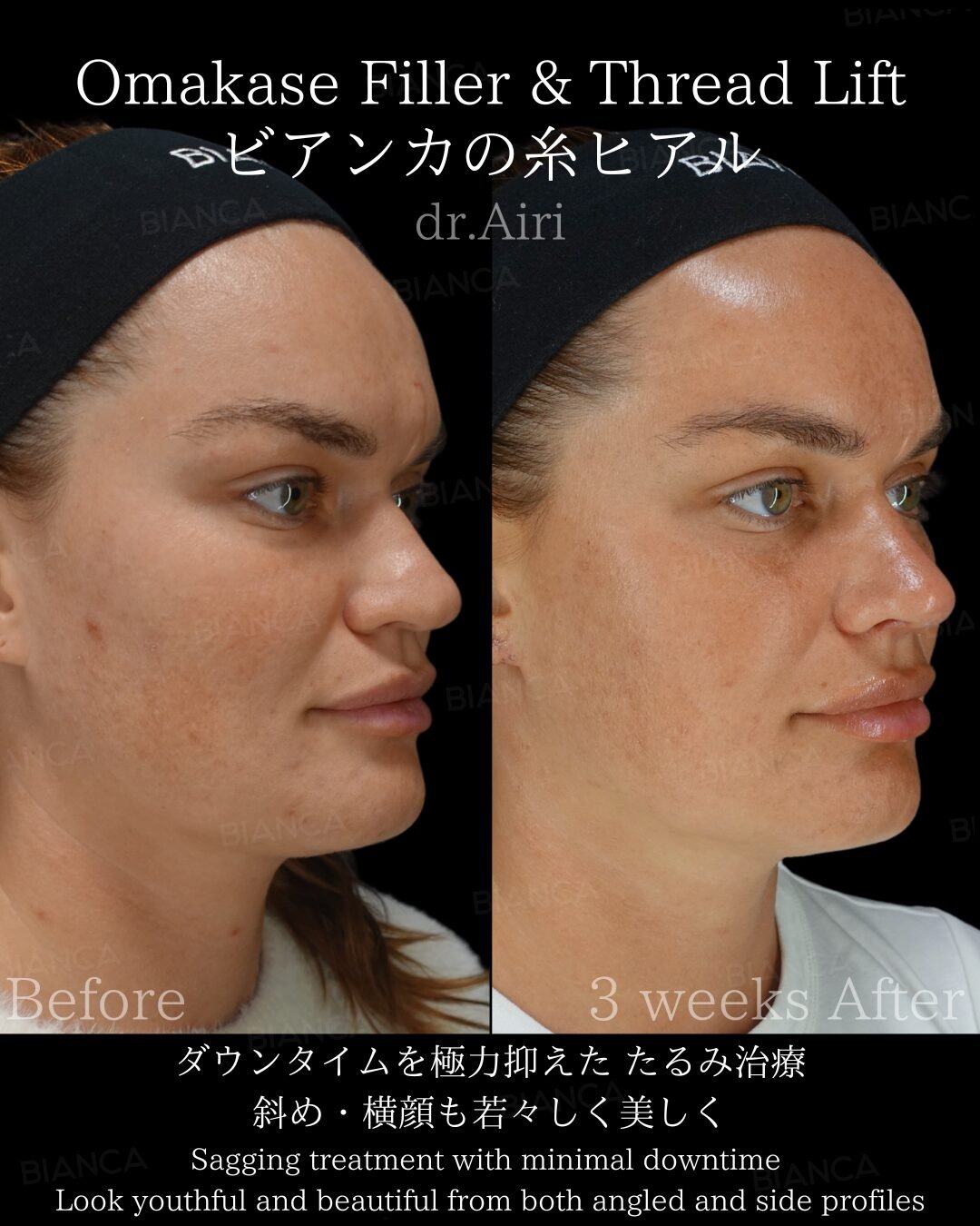 Botox Marionette Lines Explained: A Guide to Aesthetic Surgery in Tokyo