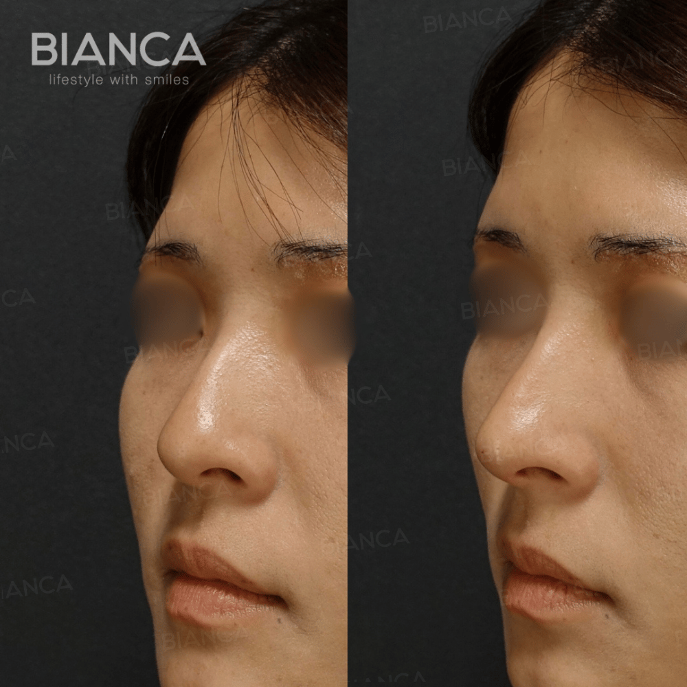 Rhinoplasty without surgery, only at BIANCA Clinic