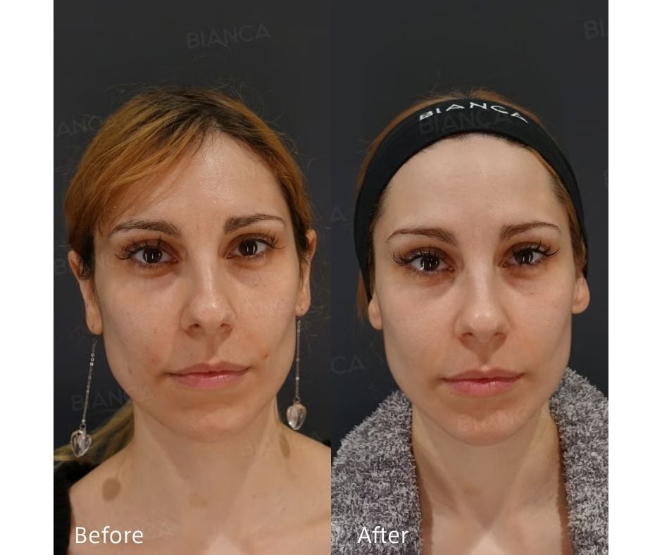 Hyaluronic Acid Injection Face: A Guide to Treatment and Clinics in Tokyo