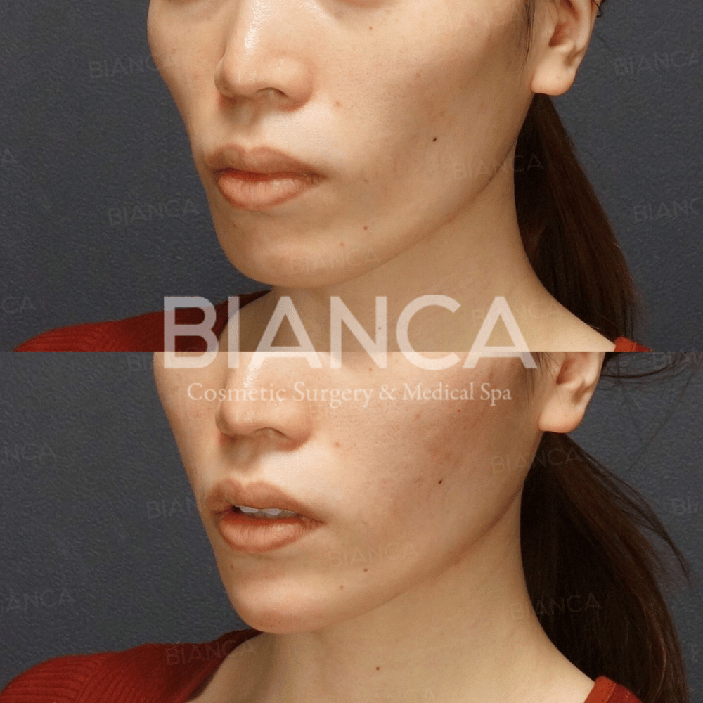 Fillers for Jowls: Lift, Define, and Rejuvenate | Aesthetic Surgery Guidance in Tokyo