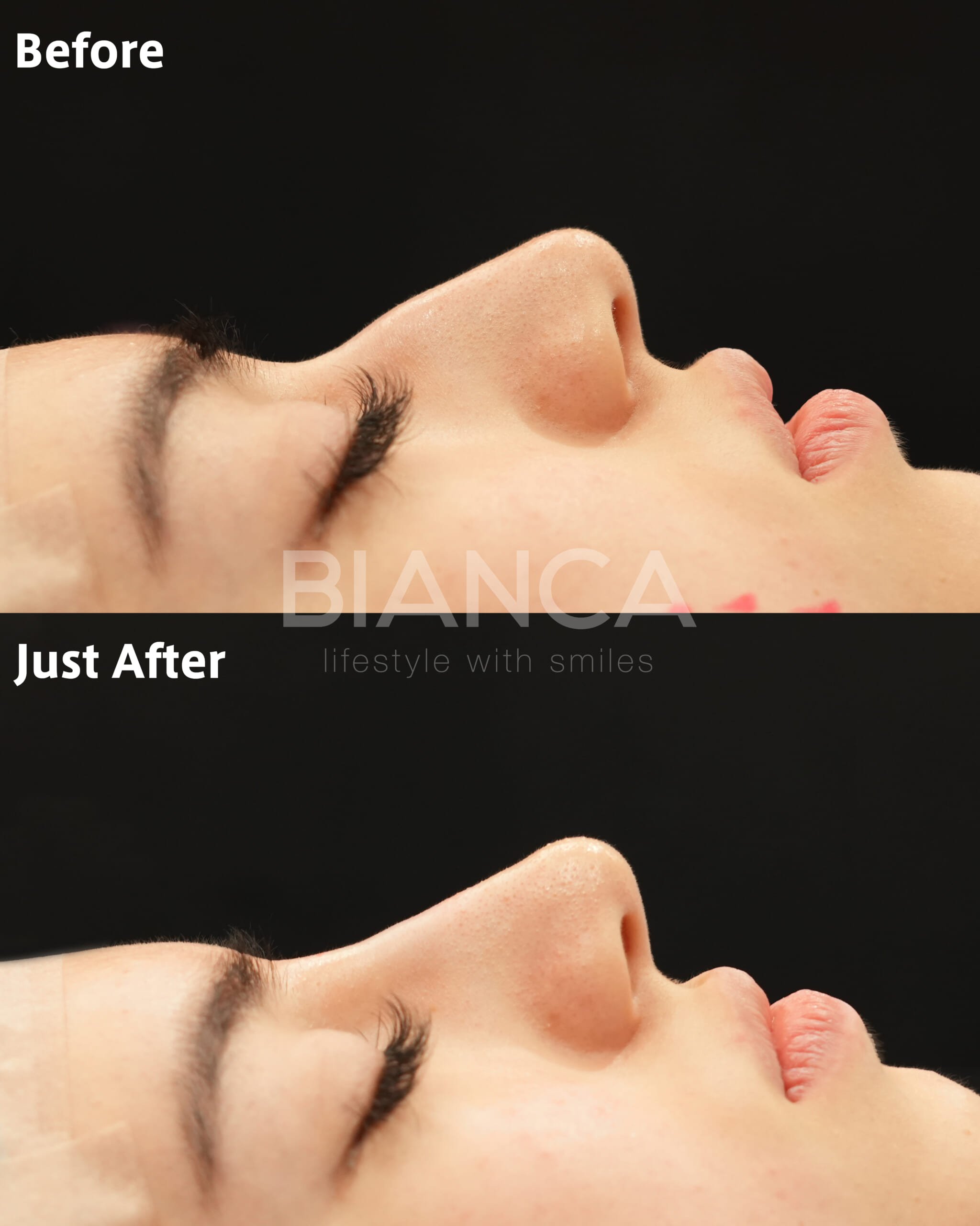 Smooth Confidence: A Beginner’s Guide to Dermal Filler Injections