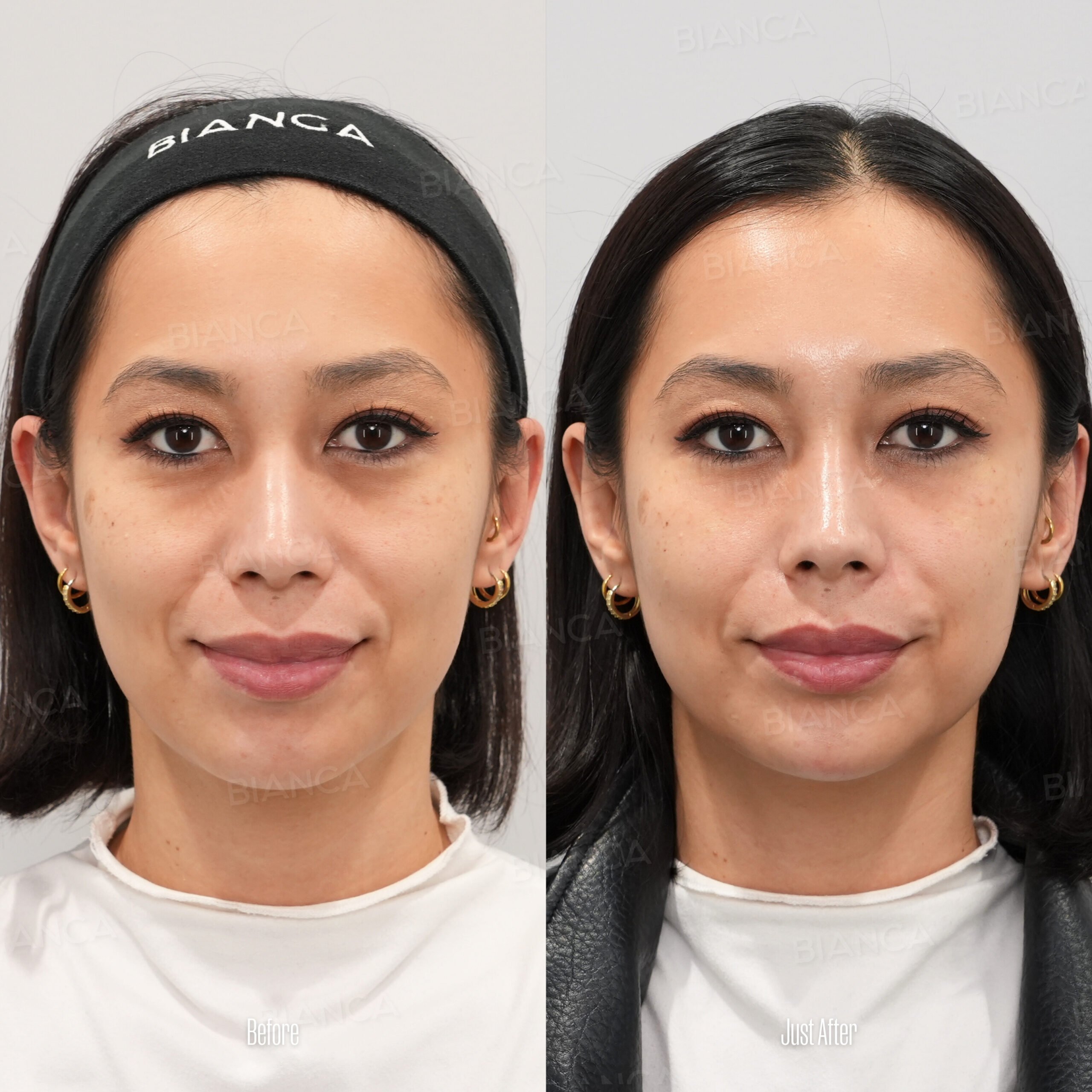 Baggy Eye Surgery: Plastic Surgery Precision with Proven Results in Tokyo