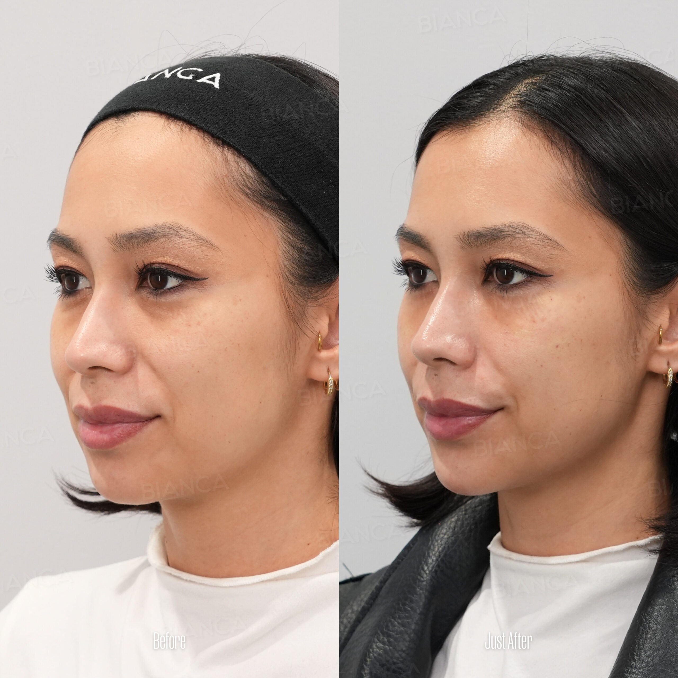 Chin Augmentation: Achieving Facial Harmony With Beautiful Results