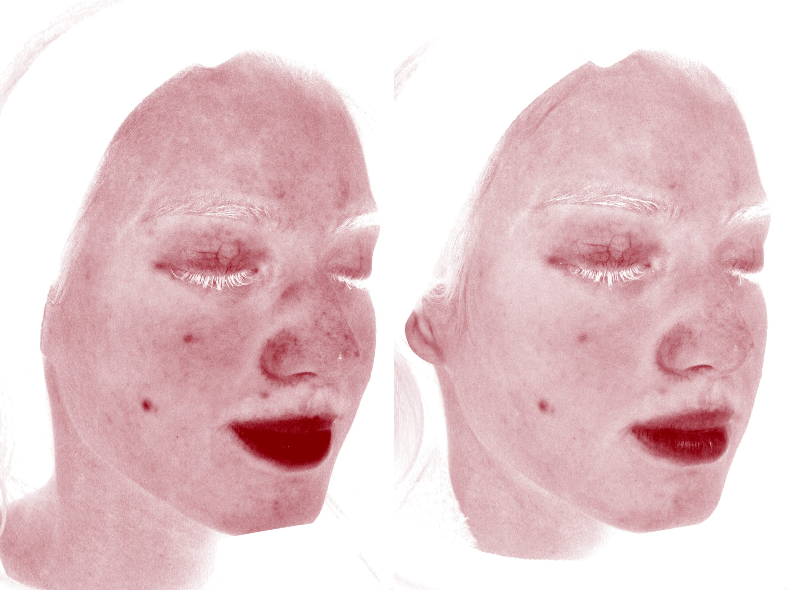 HydraFacial Japan: Fresh, Dewy Skin in Tokyo Without Aesthetic Surgery Downtime