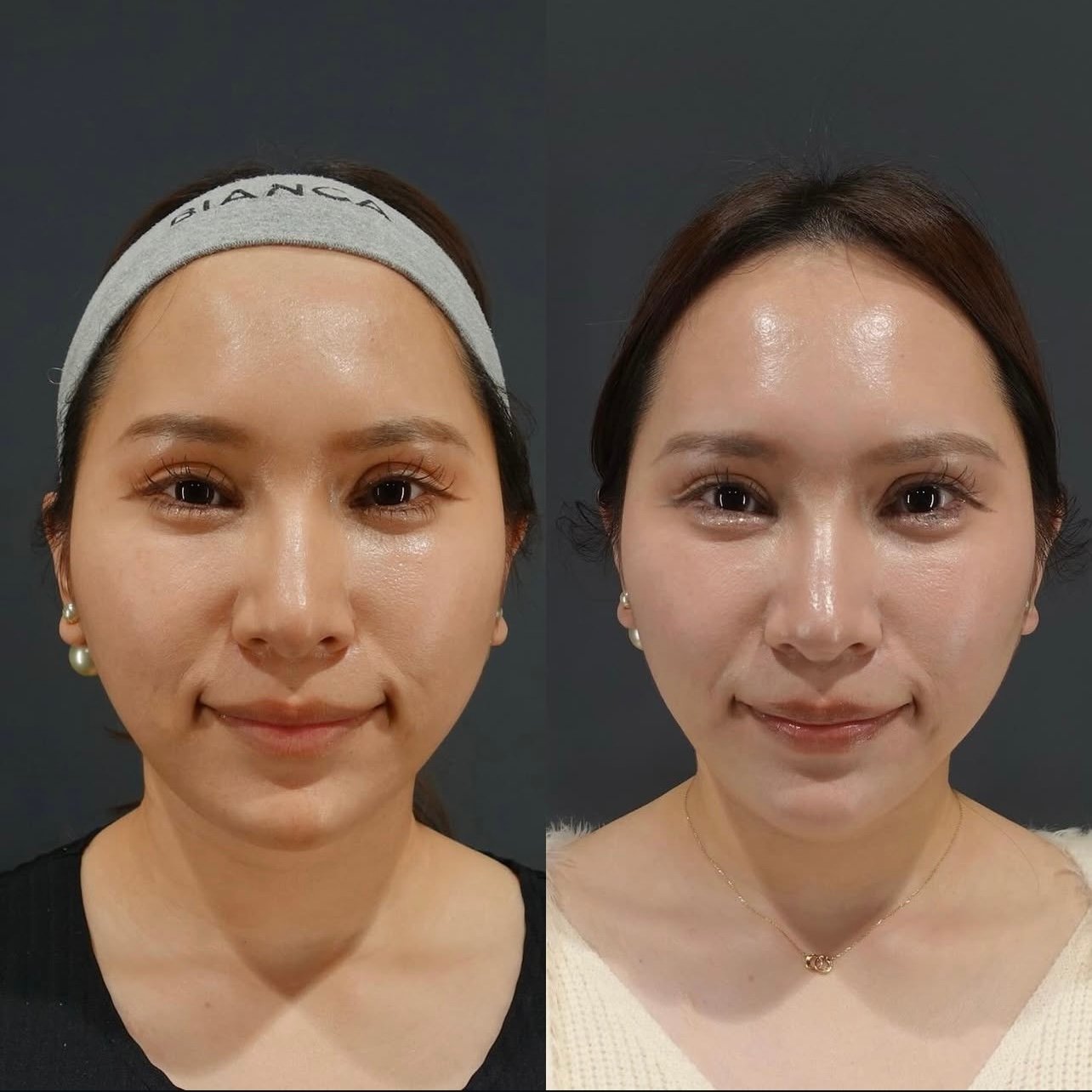 Buccal Fat Removal Tokyo: A Doctor-Guided, Patient-Friendly Guide to Slimmer Cheeks