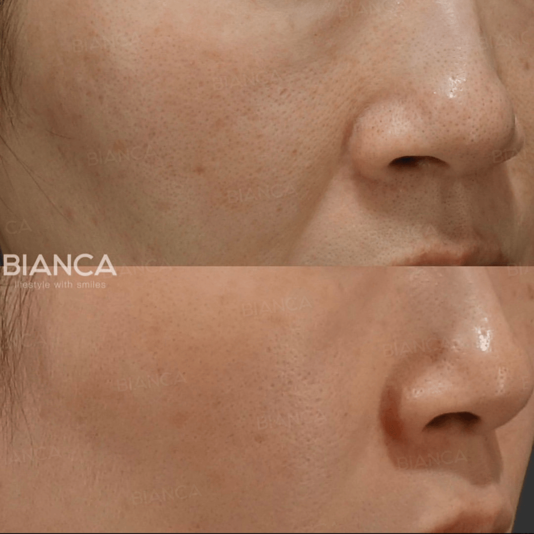 Orange Peel Skin: An Expert Guide to Smoother Texture in Tokyo