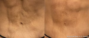 morpheus8 mommy makeover｜Trust BIANCA in Tokyo, Japan for morpheus8 mommy makeover and postpartum skin treatment. morpheus8 mommy makeover BIANCA in Tokyo, Japan