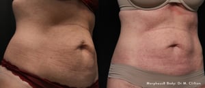 morpheus8 mommy makeover｜Trust BIANCA in Tokyo, Japan for morpheus8 mommy makeover and postpartum skin treatment. morpheus8 mommy makeover BIANCA in Tokyo, Japan