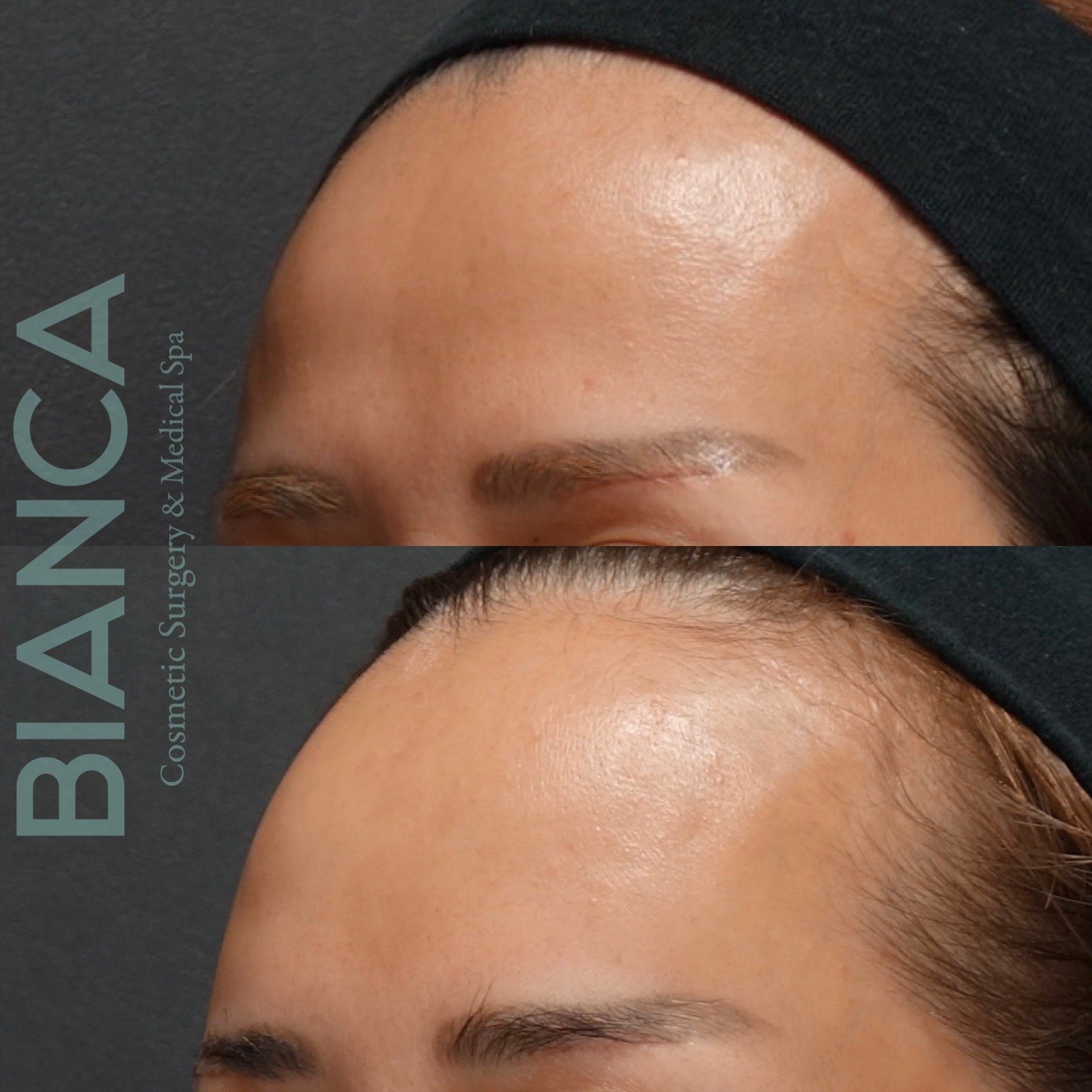 Fillers Voluma: Presenting The Latest Treatments in Aesthetic Surgery