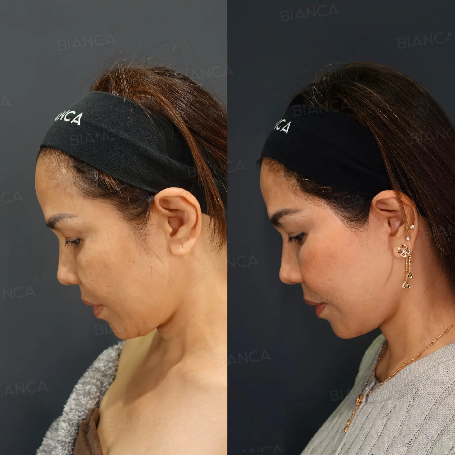 Plastic Surgery: Board-Certified Surgeon Expertise in Tokyo with BIANCA CLINIC