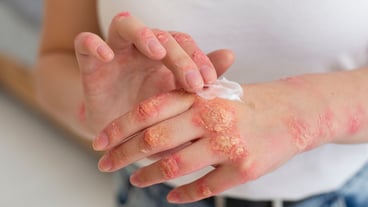 Hands of patient suffering from psoriasis