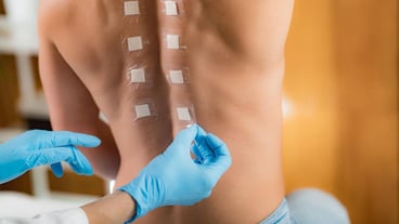 Doctor Doing Skin Allergy Test