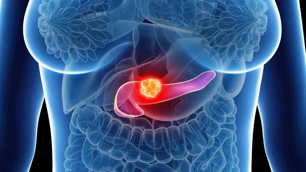 cancer-pancreas-6fd802ec8069ba