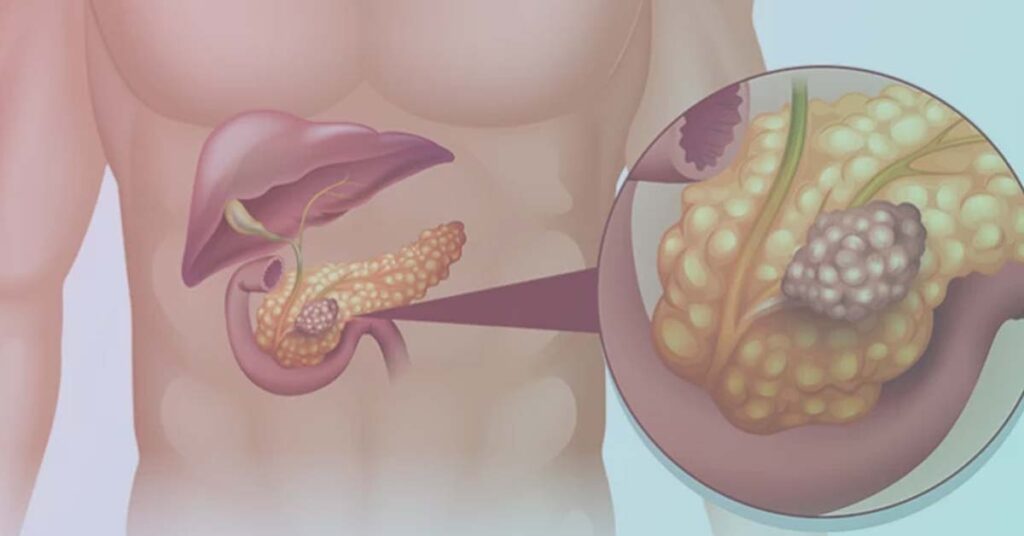 Cancer-no-Pancreas-Sintomas-Tratamento-e-Possibilidade-de-Cura-1024x536