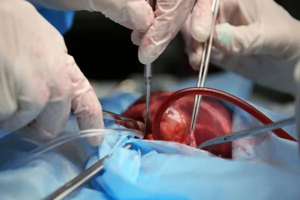 medicos-realizando-transplante-de-coracao