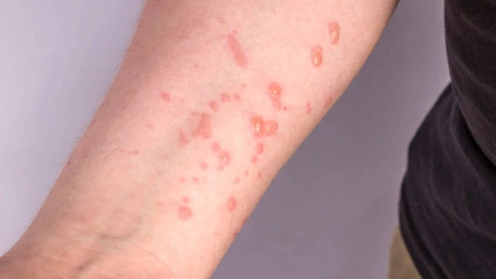 mpox-ariola-2358