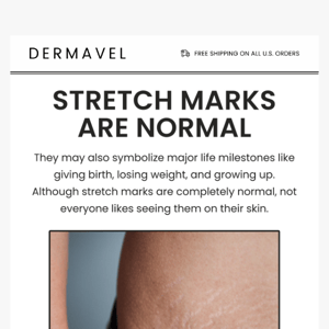 How to easily minimize stretch marks