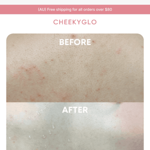 If you have body acne, read this