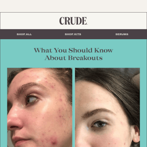 What You Should Know About Breakouts / Lessening the burden of acne 💪