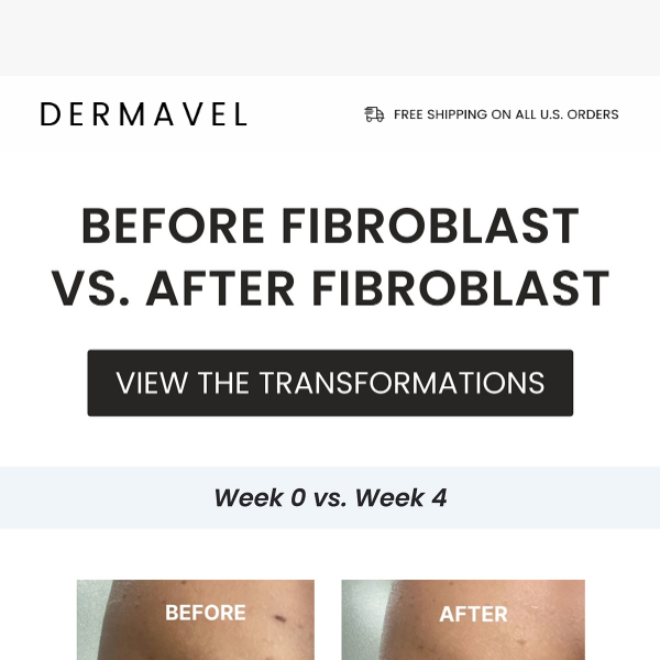 Unbelievable 4-week mole & freckle transformation