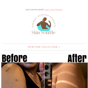 Get your bikini line cleared of hyperpigmentation & dark spots. - Skin  Souffle