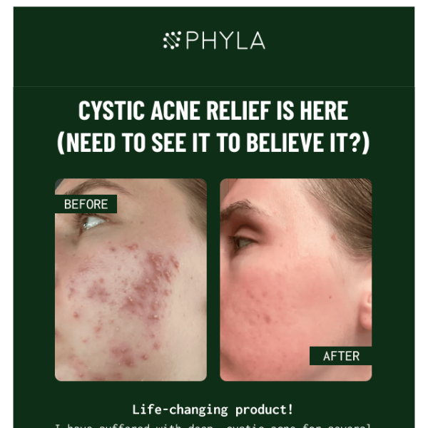 Say goodbye to cystic acne by 2023.