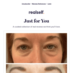    You're in luck — real eyelid surgery reviews just for you! 