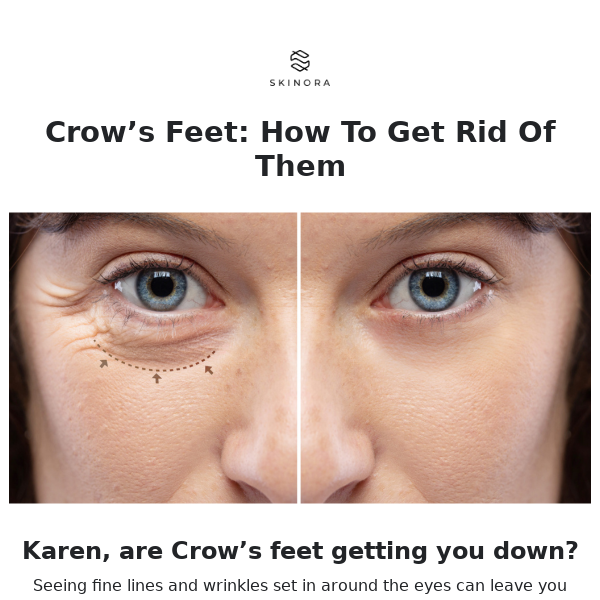 Crow’s Feet: How To Get Rid Of Them 🦅