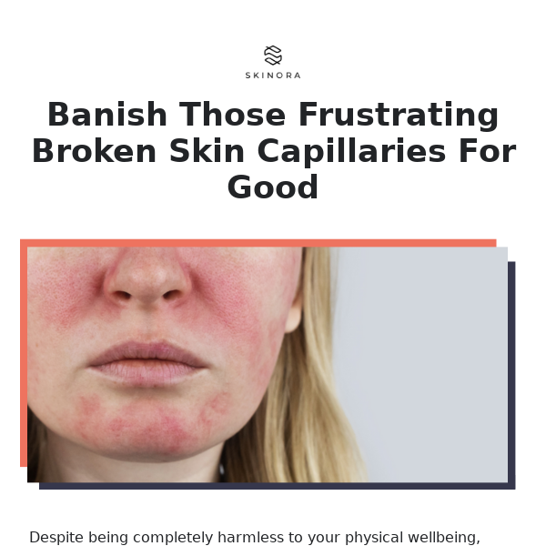 Banish Those Broken Skin Capillaries For Good