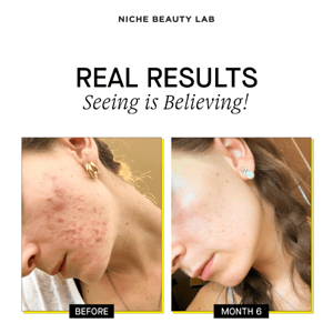 Seeing is believing! 😱 Get blemish-free skin