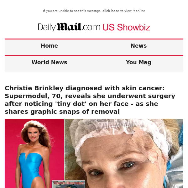 Christie Brinkley diagnosed with skin cancer: Supermodel, 70, reveals she underwent surgery after noticing 'tiny dot' on her face - as she shares graphic snaps of removal