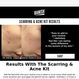 Sharing Acne Scar Results!