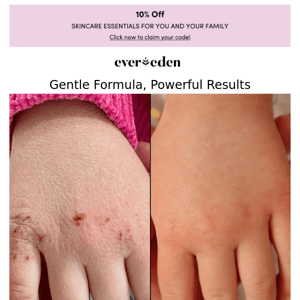 A baby-approved eczema treatment