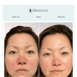 Transformative results using Omnilux 🙌