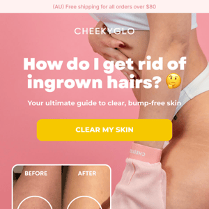 How do I get rid of ingrown hairs?