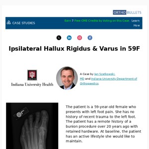 New Case: Ipsilateral Hallux Rigidus and Varus in 59F