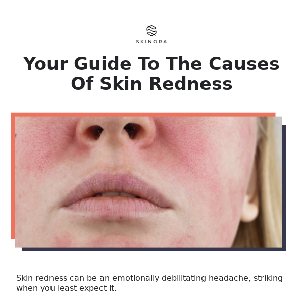 What is skin redness and how to deal with it