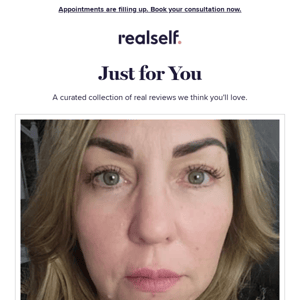 Sculptra totally transformed her face - RealSelf