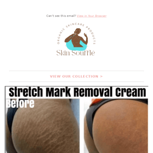 Perfect blend that will improve the appearance of stretch Marks.