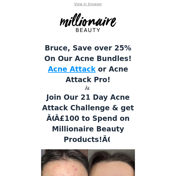 Bruce, Grab 35% OFF - New Acne Bundles with Crazy Savings!!