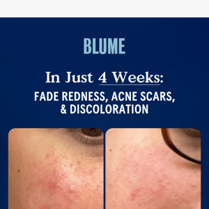 Fade scars & discoloration in 4 weeks 🌟