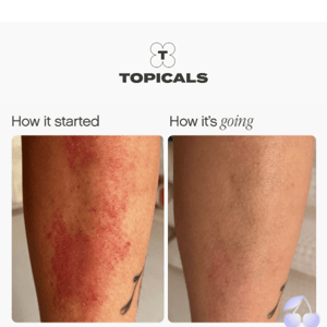 “My eczema flare-up completely disappeared”