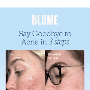 Rid acne in 3 steps 🫧