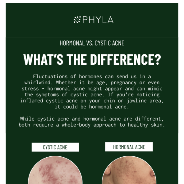 The difference between hormonal & cystic acne