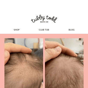 Got Cradle Cap?