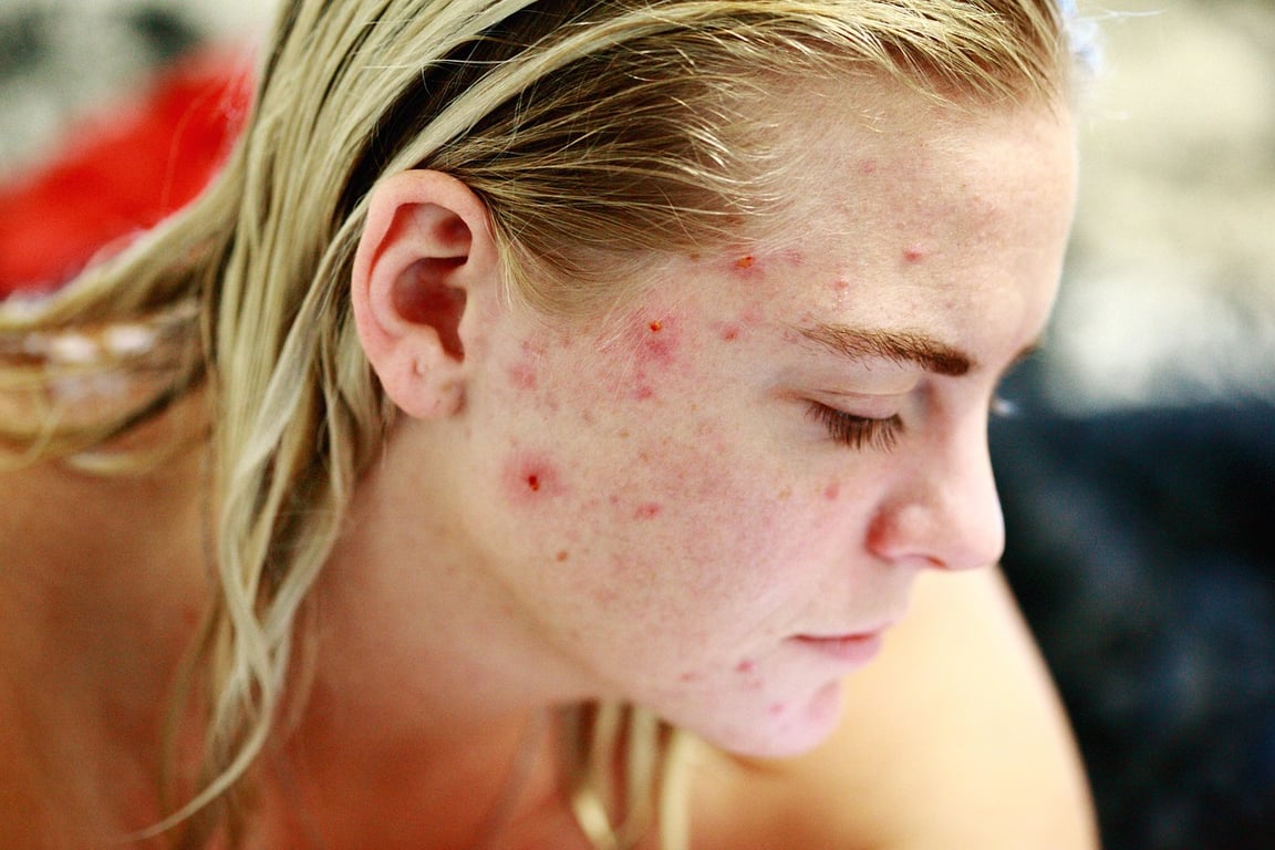 AI blemish remover before photo - casual portrait with uneven skin texture