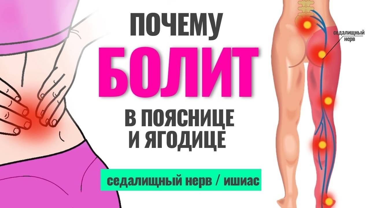 Причины возникновения и симптомы защемления седалищного нерва
