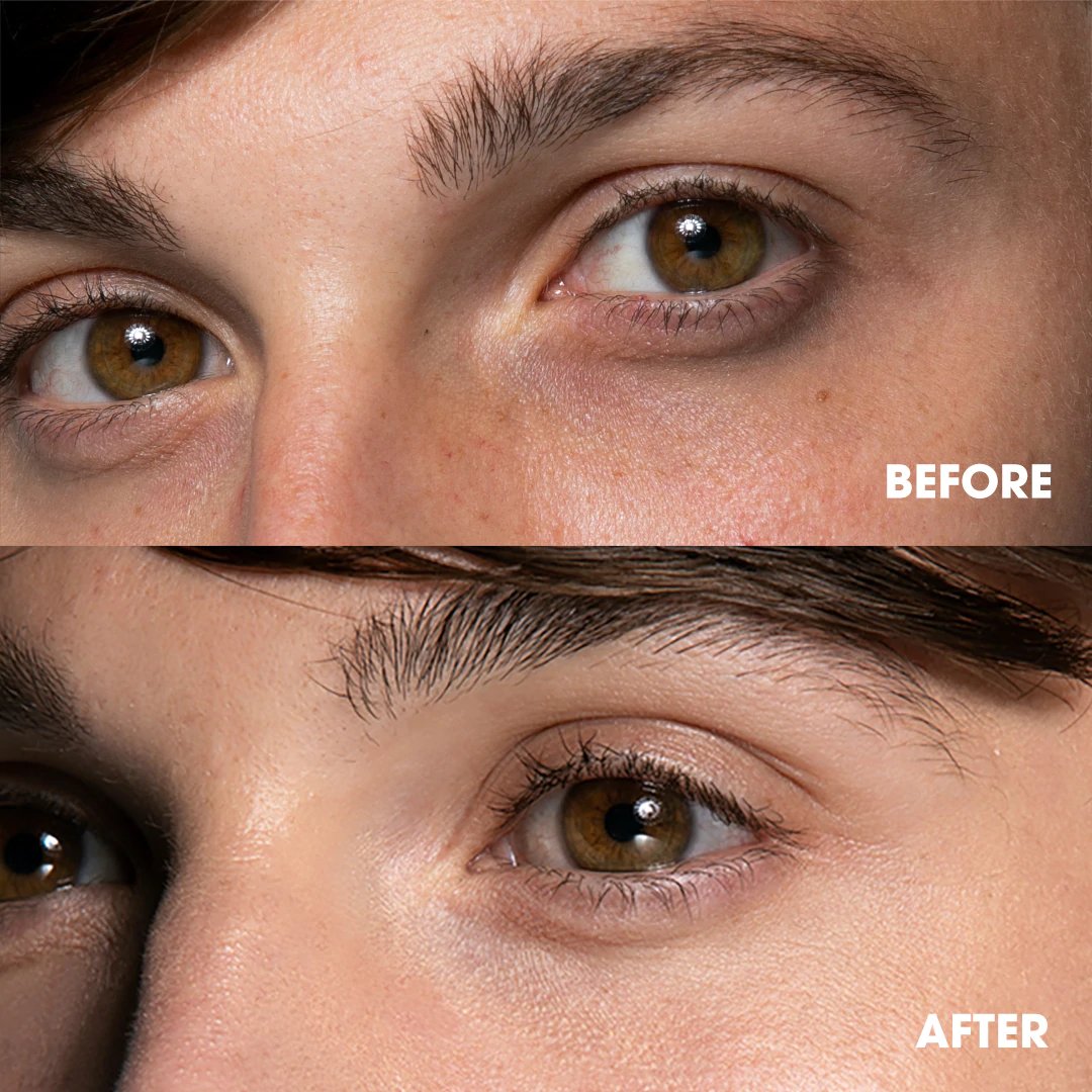 Getting rid of dark circles is easy – if you follow these 3 steps